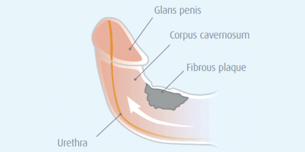 Νόσος Peyronie - Πεικη κάμψη