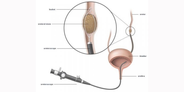 Ουρητηροσκοπικη λιθοτριψια