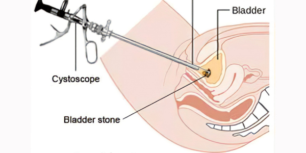 Κυστεολιθοτριψία