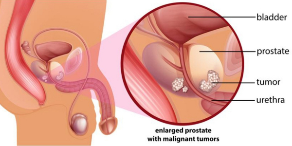 Καρκίνος προστάτη