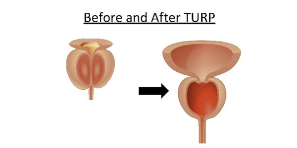 Διουρηθρική προστατεκτομή ΤURP